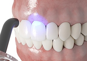 3D render of dental bonding