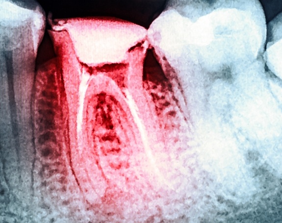 X-ray of tooth in need of emergency dentistry