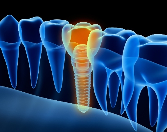 3 D rendering of smile with dental implant replacement tooth