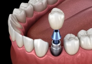 Aniamted smile during dental implant supported dental crown placement